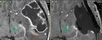Dr hemingway has received educational and travel grants from merck serono and bayer and biogen. Ismrm19 Cns Tumors