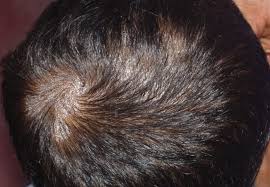 If your hair loss was due to lamisil then yes, once you stop taking it your hair loss problem will resolve itself. Do Fungal Infections Cause Hair Loss Hairguard
