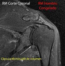 Rm Hombro Congelado Mri Frozen Shoulder Movie Posters Movies