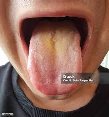 Image result for yellow tongue infection