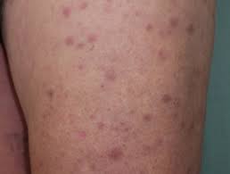 Cancer has been one of the leading reasons for deaths worldwide and blood cancer is a widely prevalent type of cancer. Leukaemia Cutis Dermnet Nz