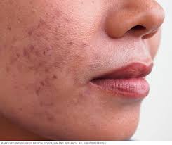 Read my story to see what worked and what changed my life. Acne Symptoms And Causes Mayo Clinic