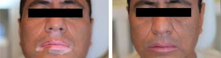 Any location on the body can be affected, and most people with vitiligo have white after the white patches appear, they may stay the same for a while, but later on, they might get bigger. Vitiligo White Spots Leucoderma Vitiligo Treatment Vitiligo Clinic