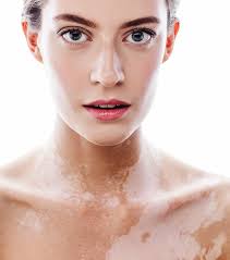 Image result for Vitiligo