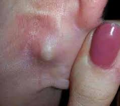 The symptoms can vary depe. Cyst Behind Ear Causes Symptoms Home Remedies