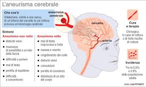 Quando una piccola arteria aterosclerotica si rompe, nel cervello, a causa di una pressione arteriosa cronica. La Ragazza Di 14 Anni Morta Per Un Aneurisma Come Riconoscerlo Sintomi E Rimedi