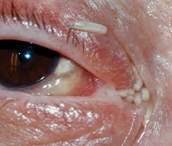 Image result for Myiasis