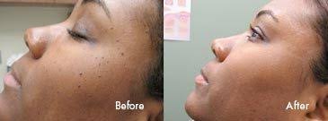 We did not find results for: Mole Removal Birmingham Homewood Chelsea Al Skin Wellness Dermatology