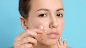 Cara Cerdas Pakai Acne Patch Menurut Dokter, Biar Tak Iritasi dan Over  Eksfoliasi