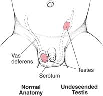 Image result for Undescended Testicle