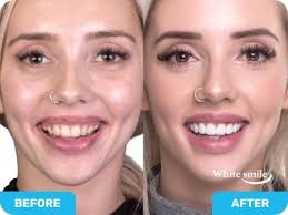 White smile