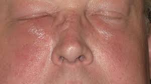 Image result for phlegmon on face)