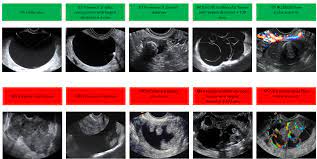 One thing would need to see a lot of times things can happen that ovary on which are simple to follow and even if they. Iota Simple Rules And Srrisk Calculator To Diagnose Ovarian Cancer Iota Group