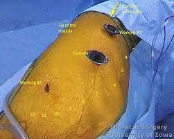They were shocked, mckeown said of the gangsters when the raids went down, mostly in san jose and in north santa clara county and modesto and conducted by swat officers. Esophagectomy Three Field Mckeown Laparotomy And Right Thoracoscopy Thoracotomy With Cervical Anastomosis Iowa Head And Neck Protocols
