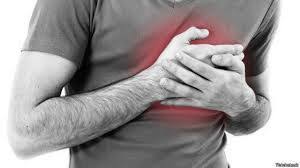 Sintomas De Infarto Y Dolor De Pecho