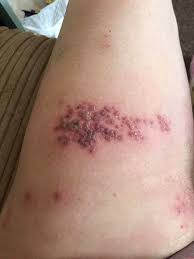 You've probably heard about chickenpox, but what about shingles? 🤔  Shingles (known as herpes zoster) is a viral disease that causes severe  nerve pain. The virus can occur at any age but
