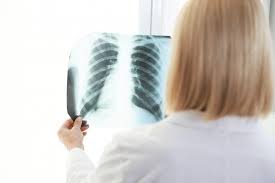 Image result for Chest XRay