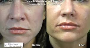 #removelaugglines #wrinkleshello everyone in this video i tried to cover all your queries about laugh lines, watch till end so you will understand each and e. Solution For Facial Wrinkles And Lines