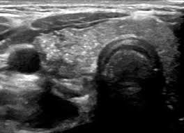 Nov 26, 2015 · introduction. Sonographic Evaluation Of Pediatric Thyroid Nodules Radiographics