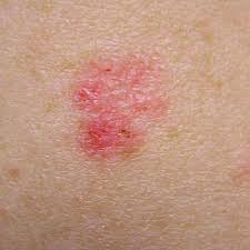 Can melanoma skin cancer be found early ? Types Of Skin Cancer Pictures Skin Cancer