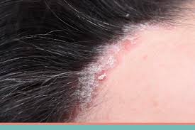 A forma mais comum é a psoríase em placas. Tratamento Contra A Psoriase Clinica Dedicada Ao Tratamento Da Psoriase Em Bh