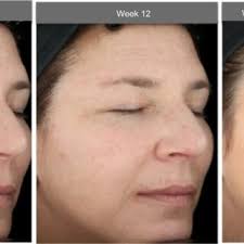PDF) Facial primer provides immediate and long-term improvements in  mild-to-moderate facial hyperpigmentation and fine lines associated with  photoaging