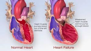 Maybe you would like to learn more about one of these? Laporan Pendahuluan Askep Gagal Jantung Kongestif Gjk Congestive Heart Failure Chf