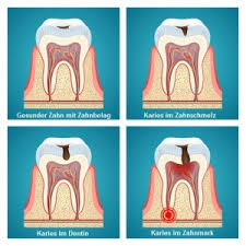 If that man has a cavity in his tooth, i want to know about it.: Kariesbehandlung In Der Zahnarztpraxis P Tomovic In Frankfurt Westend