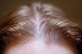 These changes also lead to symptoms like menstrual cycle irregularity, dry skin,. Pictures Thinning Hair Hair Loss In Women