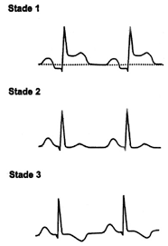 Le diagnostic repose sur les symptômes, un frottement péricardique à l'auscultation (bruit superficiel et intermittent à 3 temps, ou systolique et diastolique), des anomalies à l'ecg. Ecg Archives Medical Actu