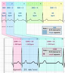 Ecg Rate Interpretation Litfl Medical Blog Ecg Library