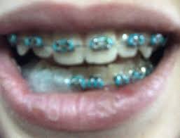 Braces Colors Black And Blue Teal Braces In 2020 Braces Colors Teal Dark Teal