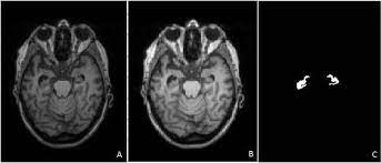 دیتاست سگمنت هیپوکامپوس در ام آر آی MRI Hippocampus segmentation dataset