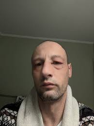 Anything ok to use for styes ???