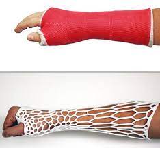 3 D Casts So Cool That You Ll Almost Want To Break A Bone Ankle Cast Broken Ankle Cast Broken Ankle