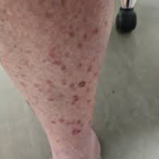 Image result for liver spots on legs