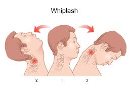 Some car accident injuries can have painful or uncomfortable side effects that can last for weeks or. Whiplash Novus Spine Pain Center In Lakeland Florida