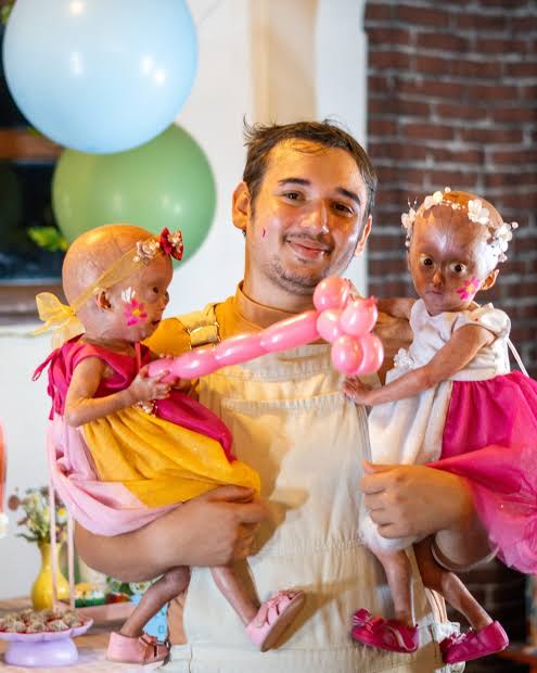 Únicas gêmeas do mundo com síndrome da velhice precoce completam 4 anos