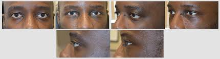 Customized Infraorbital Rim Implant Beverly Hills