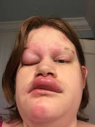 31 Allergic Reactions That Actually Hurt To Look At