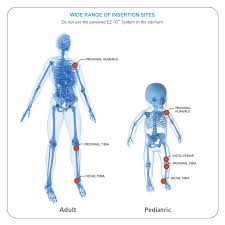 Image result for Intraosseous Access