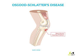 The best treatment for pain behind the knee will depend on what's causing the pain. Pain Behind Knee Why It Hurts In Back Of Or Under Your Kneecap