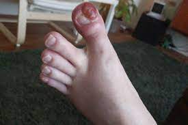 They may look like a patch or a lump or look like an ulcer. Fundraiser By Scott Milliorn Help Scott Milliorn Beat Cancer