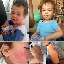 Eczema is typically pink or red. Eczema Healing Stories Tudor Ullenka