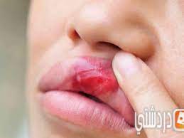 أعراض سرطان الفم وعلاجه