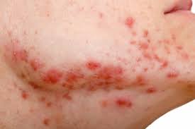 A mucormicose, também conhecida como fungo preto, é uma infecção rara, mas perigosa. 8 Tipos De Manchas De Pele Mais Comuns E Como Tirar Tua Saude