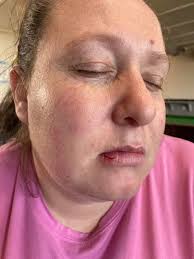 Savage seagull attack leaves tourist with burst lip after birds swipe mini  egg from her mouth