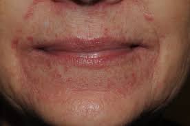 Image result for red rash face