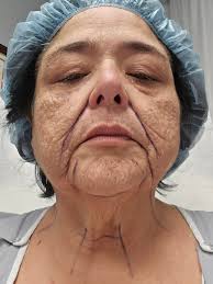 Picked a surgeon! Scheduled for March 12th. DP FL/NL, browlift with fat  transfer. Picking the surgeon is the hardest! I came across several  surgeons that I was impressed with! Nervous now about