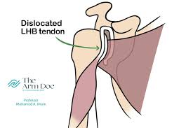 Image result for Yergason Test